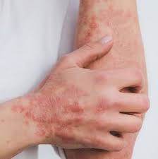 Psoriasis